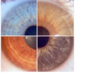 Disposition und Diathese in der Augendiagnose