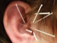 Arbeitskreis - Ohrakupunktur
